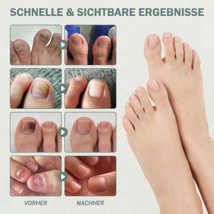 ELAIMEI® Fussnagel Patches